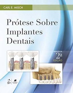 Prótese sobre Implantes Dentais