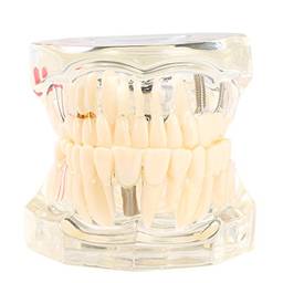 Romacci Implantação dentária transparente para doença de implante dentário - Ferramenta de ensino de dentes - Dental adulto Typodont - modelo removível de dentes