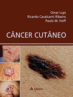 Câncer Cutâneo (eBook)